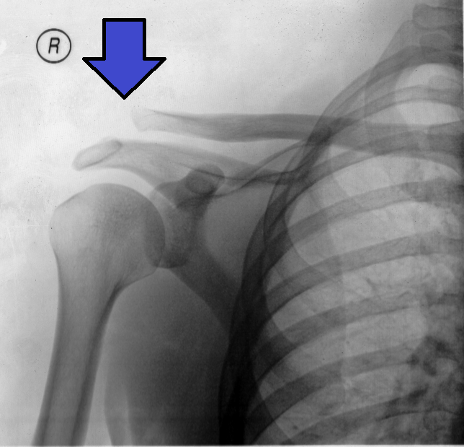 Enhanced X-Ray of a right acromioclavicular joint sprain with an arrow highlighting the separation between the acromion and the lateral distal clavicle.