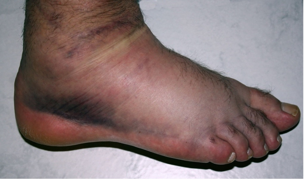 Lateral view of the ankle and foot complex following a lateral ankle sprai with edema and ecchymosis evident in the lateral aspect of the right ankle.
