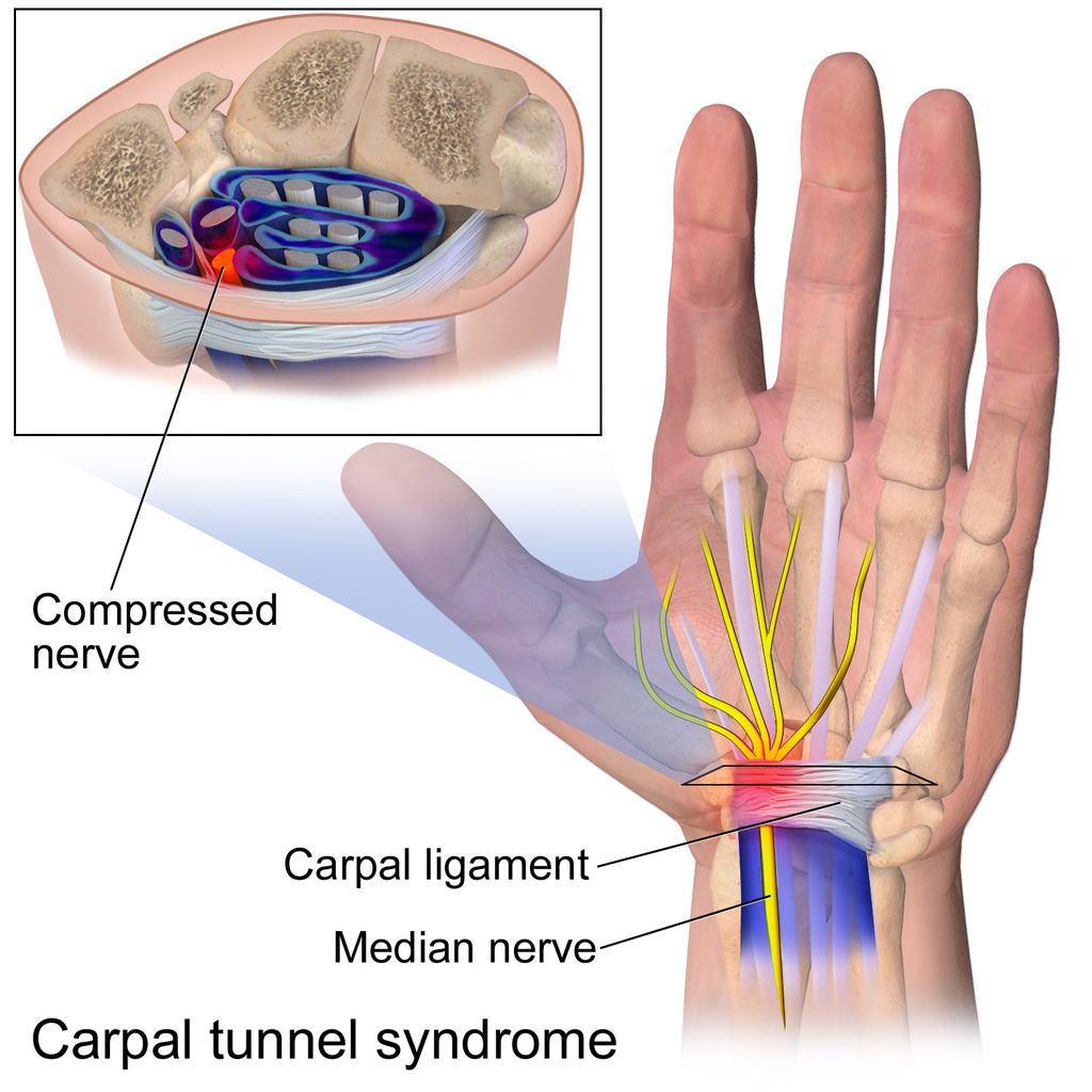 Identification of the relevant anatomy for carpal tunnel syndrome with the median nerve presented in a transverse view of the carpal tunnel box. Median nerve compression at the flexor retinaculum is shown.