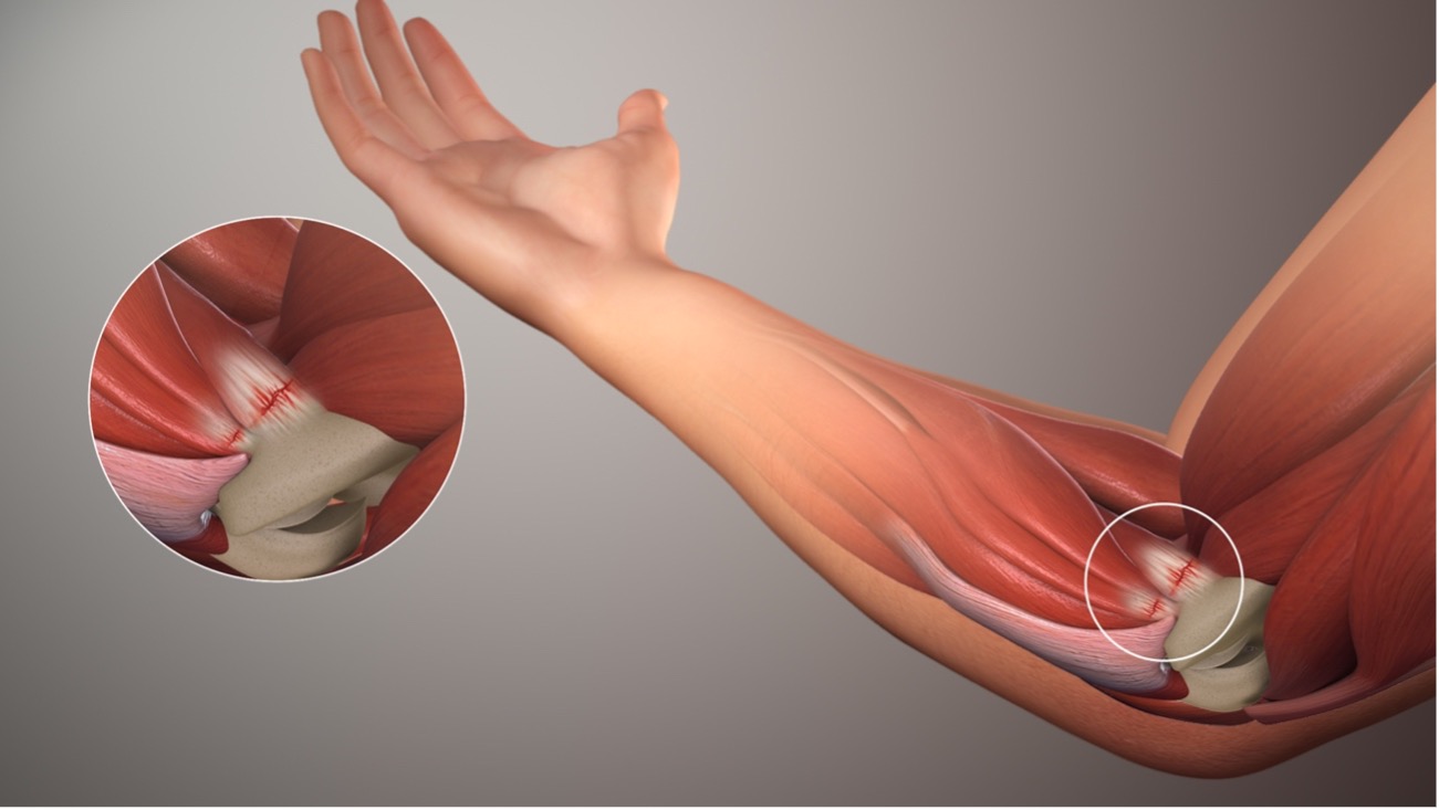 The relevant bony and muscular anatomy of the medial elbow for a diagnosis of medial epicondylitis, which is a disorder of the tendon that is demonstrated at the common flexor origin of the elbow complex.