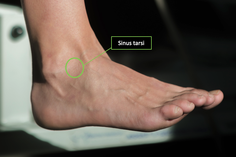 Identification of the sinus tarsi on the anterolateral aspect of the right foot.
