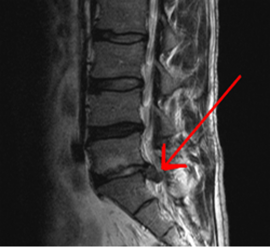 Sagittal view of an L5-S1 disc disc herniation using MRI.