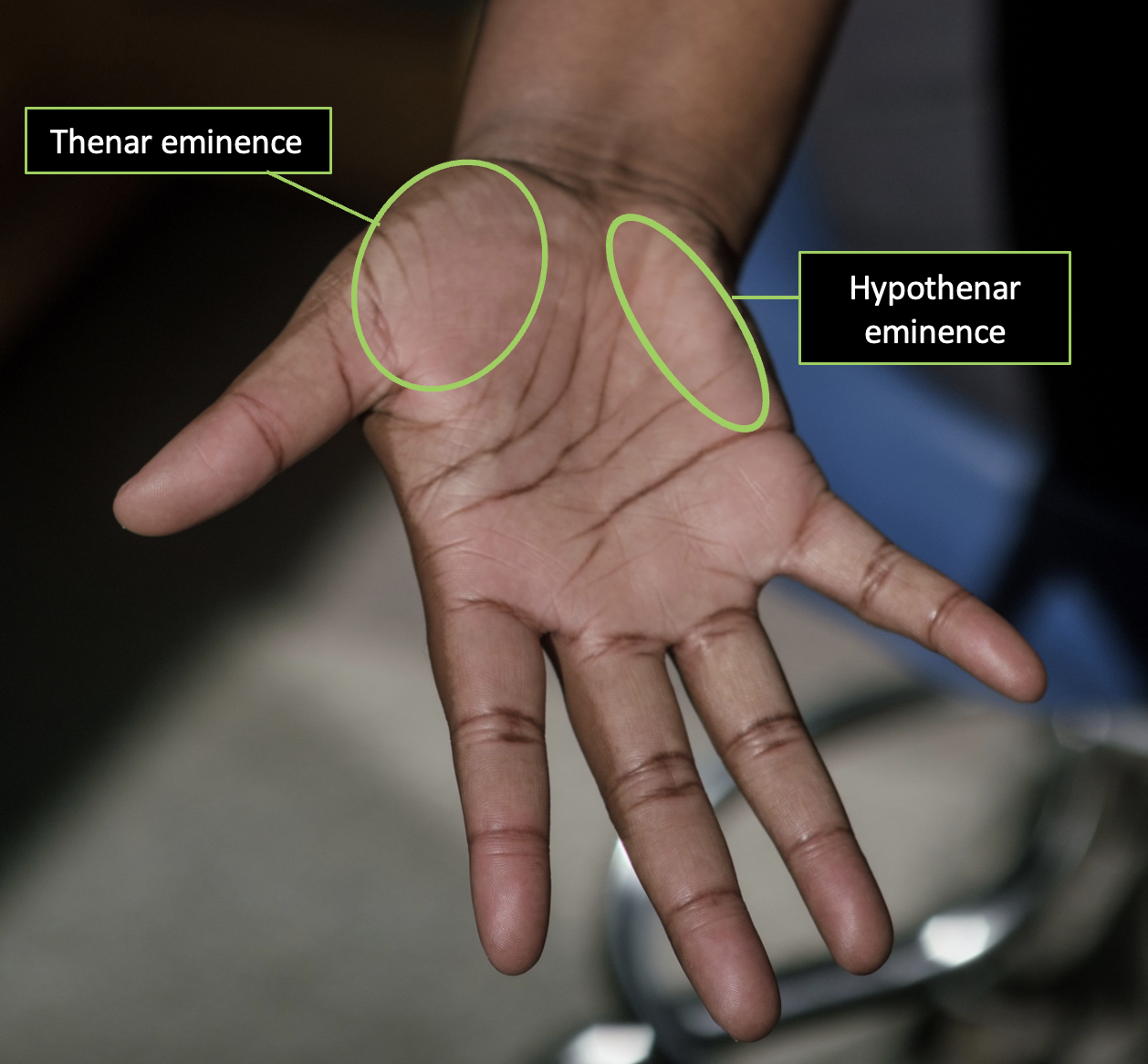 Palmar view of the thenar and hypothenar eminences of the right hand with eminences individually identified.